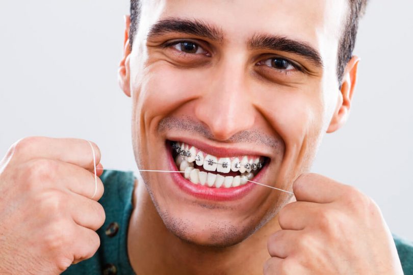 Como usar fio dental com aparelho ortodôntico?